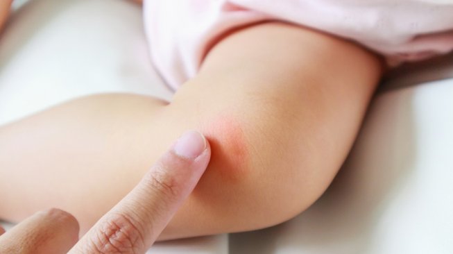 Obat alergi kulit pada orang dewasa